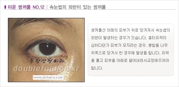 [두한성형외과 경쟁력 눈성형] - [나에게 맞는 맞춤 쌍꺼풀 찾기] 관련 이미지 12