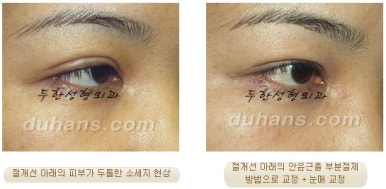 Best Place for Revision Eyelid Surgery, Duhan Plastic Surgery - Lowering Double Eyelid Line image 27