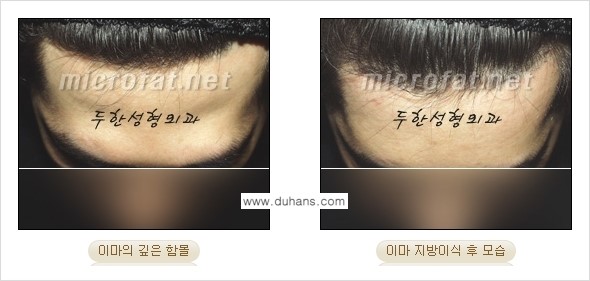 [두한성형외과의 경쟁력 있는 지방이식] - [이마 미세지방이식 2.] 관련 이미지 8