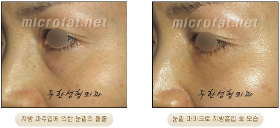[Duhan Plastic Surgery Liposuction] - [Facial Liposuction] image 13