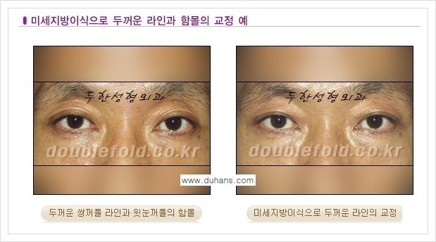 [두한성형외과 경쟁력 눈성형] - [미세지방이식으로 두껍고 어색한 라인 교정 안내 1.] 관련 이미지 4