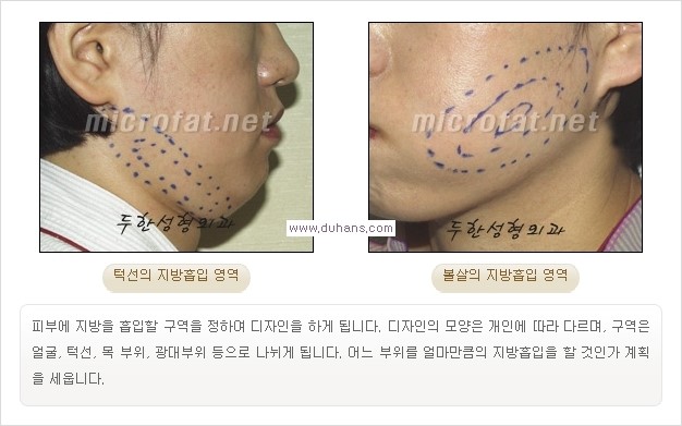 ​​[두한성형외과 경쟁력 지방흡입] - [아름다운 얼굴 윤곽선을 위한  볼살지방흡입, 턱선지방흡입 안내] 관련 이미지 4