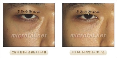 두한성형외과 눈밑수술 - 다크서클 수술 전후 관리 안내 관련 이미지 25