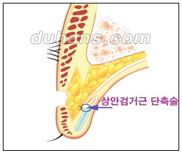 [Doohan Plastic Surgery Double Eyelid Revision Surgery] - [Double Eyelid Revision Surgery Process] image 23