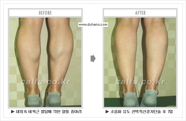 [두한성형외과 경쟁력 멀티종아리성형] - [종아리성형 방법별 전후 주의사항] 관련 이미지 14