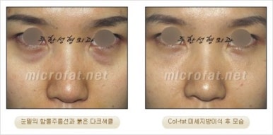 [두한성형외과 얼굴자가지방이식] - [지방이식 과정] 관련 이미지 30