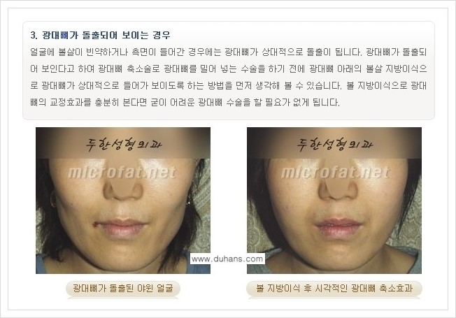 ⁠⁠[두한성형외과 경쟁력 볼살지방이식] - [심하게 야윈 주름이 있는 얼굴, 역삼각형 협소한 얼굴, 광대뼈가 돌출되어 보이는 경우 안내] 관련 이미지 15