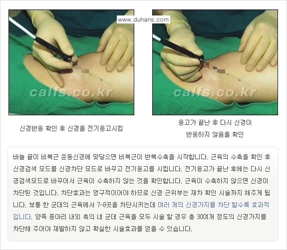 ​[두한성형외과와 날씬한 종아리 만들기!] - [간편하고 안전한 종아리 축소방법 ②] 관련 이미지 13