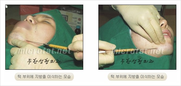 [두한성형외과 경쟁력 안면윤곽 성형 리더] - [완변한 V 라인! 턱 미세지방이식, 볼살 미세지방이식, 사각턱 보톡스 안내] 관련 이미지 11