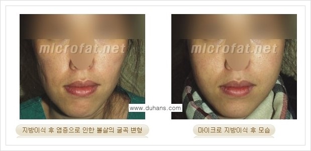 ​[두한성형외과 경쟁력 미세지방이식] - [타 병원에서 지방이식 후 발생한 굴곡현상 교정 방법 - 마이크로 지방이식] 관련 이미지 8