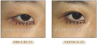 Best Place for Double Eyelid Revision Surgery, Duhan Plastic Surgery - Partial Incision Eye Revision Surgery image 37