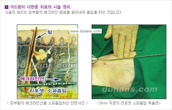 [두한성형외과 성형 FOCUS 지방흡입] - [액취증 - 다한증 초음파 컷터 지방흡입 ⑤] 관련 이미지 5