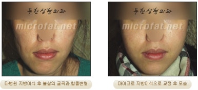 [두한성형외과 얼굴지방이식] - [볼지방이식] 관련 이미지 38