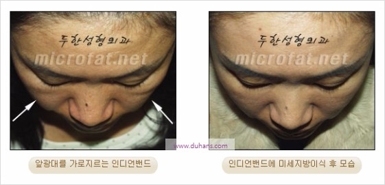 [두한성형외과 경쟁력 입체지방이식] - [인디언밴드, 앞광대주름 미세지방이식] 관련 이미지 7