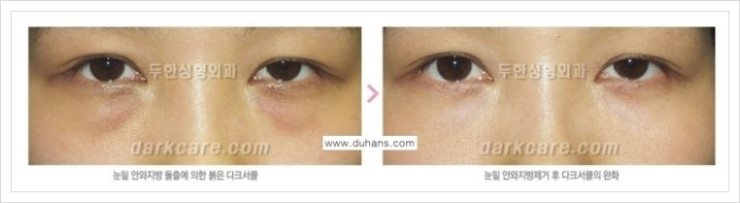 [두한성형외과 경쟁력 눈밑성형] - [눈밑 다크써클 증상과 그 증상에 맞는 치료 방법 안내] 관련 이미지 14
