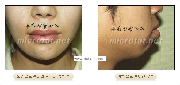 [두한성형외과 경쟁력 미세지방이식] - [부드럽고 아름다운 얼굴윤곽선 턱(하악부) 미세지방이식 안내] 관련 이미지 3