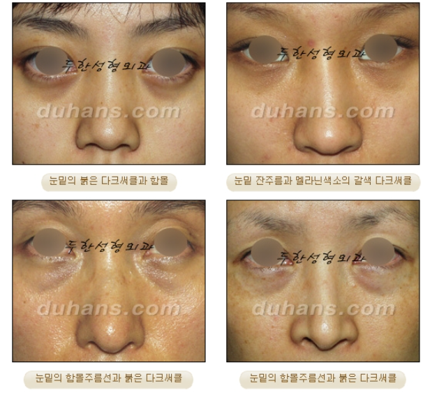 눈밑 다크써클 개선 원리 관련 이미지 2