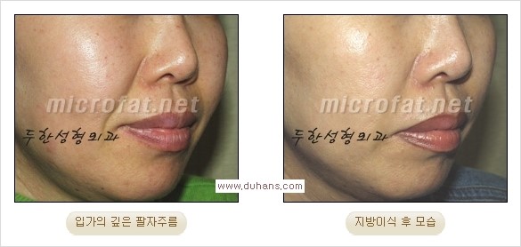 [두한성형외과 경쟁력 주름성형] - [입가와 팔자의 주름제거 지방이식 2.] 관련 이미지 5