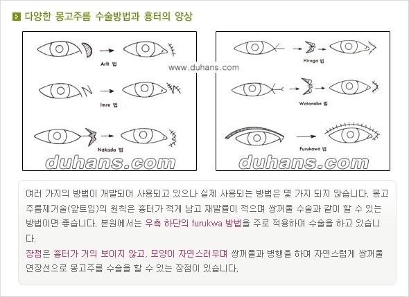 [두한성형외과 NO.1 눈성형] - [몽고주름 제거(앞트임 수술) 1.] 관련 이미지 9
