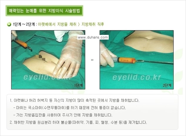 [두한성형외과 경쟁력 미세지방이식] - [꺼진(함몰된) 윗눈꺼풀 미세지방이식] 관련 이미지 5
