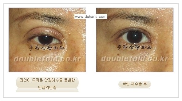 [두한성형외과 경쟁력 쌍꺼풀 재수술] - [극한의 상태에서 쌍꺼풀 재수술 안내 ①] 관련 이미지 12