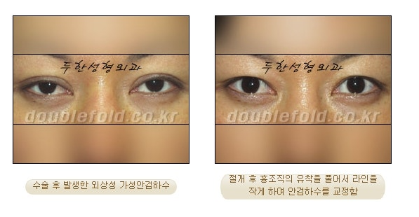 과교정 눈매 (소세지 쌍커풀 재수술, 눈매교정 재수술) 관련 이미지 9