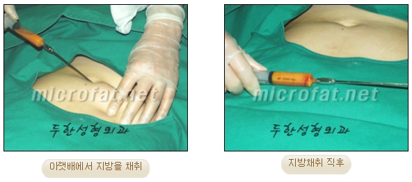 [두한성형외과 지방이식] - [다크써클, 눈​밑주름] 관련 이미지 6