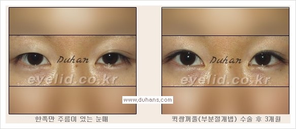 [두한성형외과 경쟁력 눈성형] - [퀵쌍꺼풀(부분절개법) 안내] 관련 이미지 9