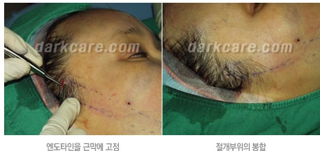 Duhan Plastic Surgery Combo Program - Dark Circles and Lifting image 13