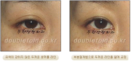 [두한성형외과 쌍커풀수술] - [눈성형 방법에 대한 자주하는 질문과 답변] 관련 이미지 14