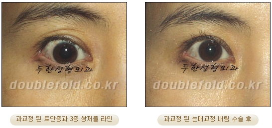 쌍꺼풀수술 두한성형외과 - 쌍커풀재수술의 문제점 관련 이미지 10