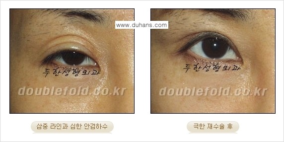 [두한성형외과 경쟁력 쌍꺼풀 재수술, 극한 눈재수술] - [망친 쌍꺼풀을 복원하는 극한 눈재수술] 관련 이미지 5