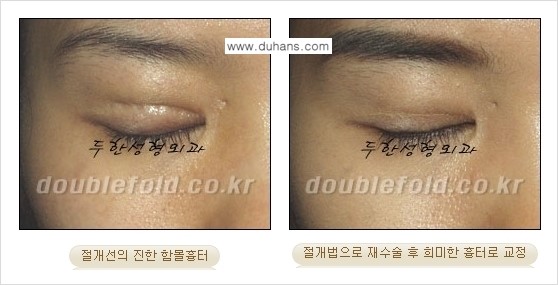 [두한성형외과 경쟁력 쌍꺼풀 재수술] - [흉터선이 진한 경우] 관련 이미지 6