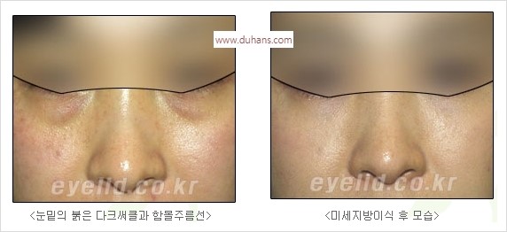 [두한성형외과 경쟁력 눈밑성형] - [눈밑 다크써클 수술 방법] 관련 이미지 15
