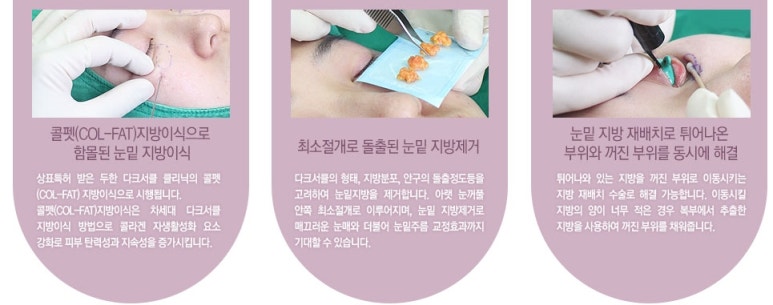 두한성형외과 눈밑수술 - 다크서클 수술 전후 관리 안내 관련 이미지 113