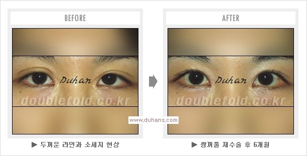 [두한성형외과 경쟁력 눈성형] - [쌍꺼풀 재수술 과정과 쌍꺼풀 재수술 실패의 원인, 쌍꺼풀 재수술의 성공 요건] 관련 이미지 8