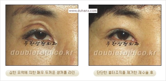 ⁠⁠[두한성형외과 경쟁력 쌍꺼풀 재수술] - [재수술 대상과 재수술의 문제점] 관련 이미지 13