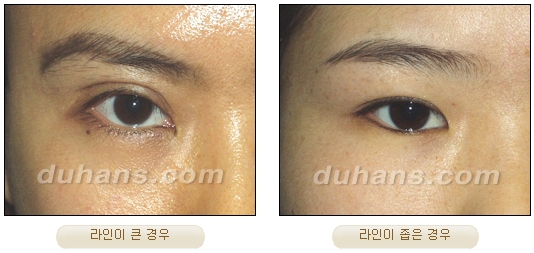 [DuHan Plastic Surgery Eye Surgery] - [Double Eyelid Surgery Guide] image 10