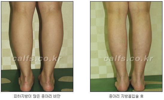두한성형외과 지방흡입 - 부위별 안전 지방흡입 관련 이미지 38