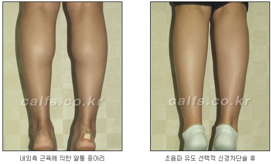 [두한성형외과 종아리퇴축술] - [NO절개! 초음파유도신경차단술] 관련 이미지 35