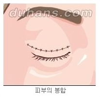 [두한성형외과 안검성형] - [상안검, 하안검] 관련 이미지 6
