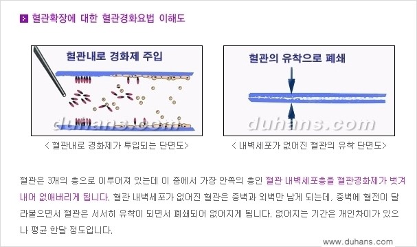 [두한성형외과 정맥 혈관 확장으로 인한 피부개선] - [손, 팔 혈관 확장] 관련 이미지 10