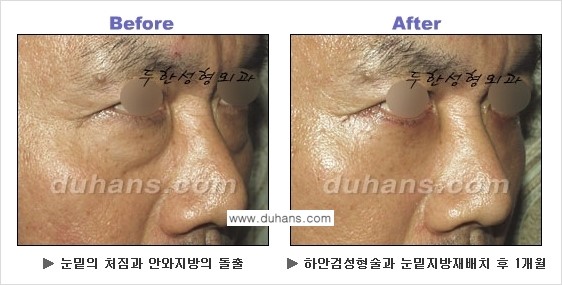 [두한성형외과의 상큼하고 환한 젊은 눈매완성] - [하안검 성형술 ②] 관련 이미지 28