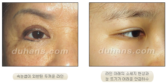 [두한성형외과 쌍커풀재수술] - [재수술 실패의 원인] 관련 이미지 1