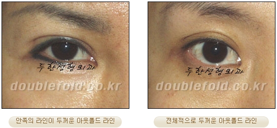 [두한성형외과 쌍커풀재수술] - [심한 소세지눈, 두줄따기, 쌍꺼풀 흉터] 관련 이미지 21