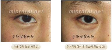 두한성형외과 눈밑성형 - 애교필러 후 눈밑재수술 관련 이미지 39
