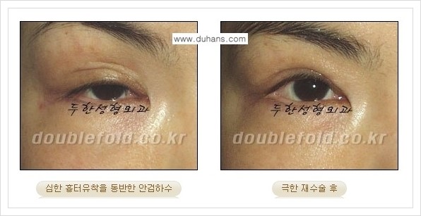 [두한성형외과 경쟁력 쌍꺼풀 재수술, 극한 재수술] - [망친 눈(쌍꺼풀) 복원수술과 일반 쌍꺼풀 재수술과의 차이점] 관련 이미지 10