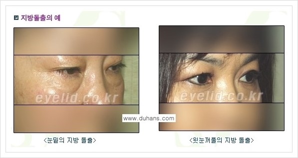 [두한성형외과 경쟁력 눈성형] - [지방제거 안내] 관련 이미지 1