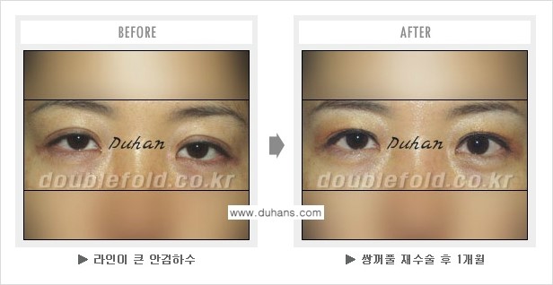 [두한성형외과 NO.1 쌍꺼풀 재수술] - [쌍꺼풀 재수술 - 푸는 수술을 하고 내원했을 경우의 문제] 관련 이미지 6