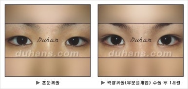 Best Place for Double Eyelid Revision Surgery, Duhan Plastic Surgery - Partial Incision Eye Revision Surgery image 22